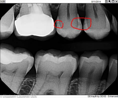 Early Decay Visible With Enhanced Digital X Rays Elizabeth Caughey