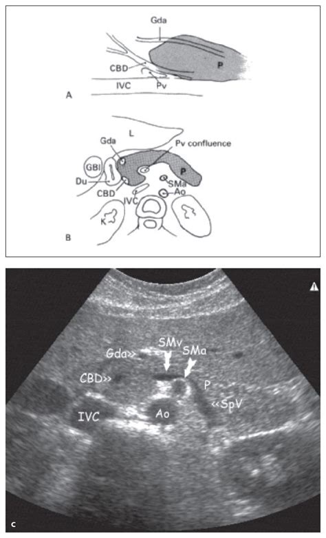 Gastroduodenal Artery Ultrasound