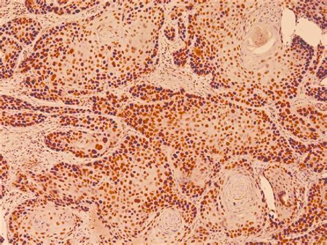 Moderately Differentiated Squamous Cell Carcinoma Of The Vocal Cord