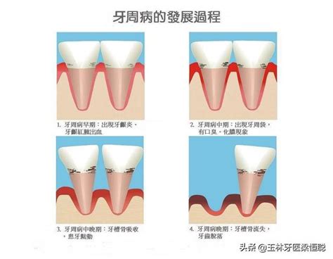 牙齦紅腫、出血是怎麼回事？ 每日頭條