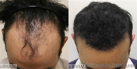 Dr H Rahal Hair Transplantation Surgical Procedure Before And After