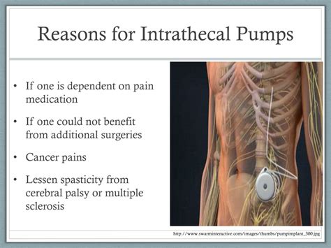 Ppt Intrathecal Pumps Powerpoint Presentation Free Download Id9415191