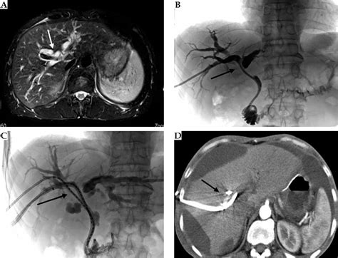 The Efficacy Of The Combination Of Percutaneous Transhepatic Biliary