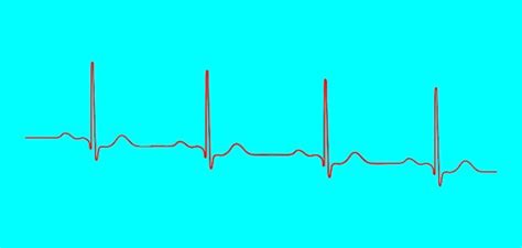 Repolarização ventricular Ciclo cardíaco ECG do coração em ritmo