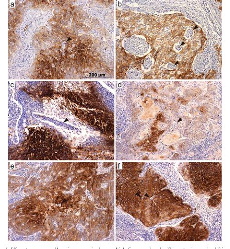 Figure From Glut Staining Of Squamous Cell Carcinomas Of The