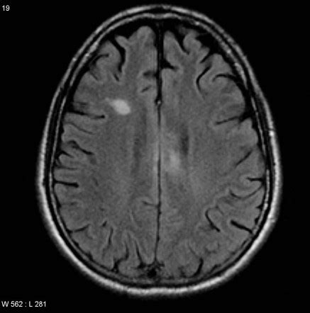 Diffuse axonal injury | Radiology Reference Article | Radiopaedia.org