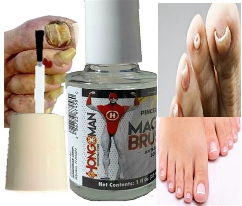 Antifungal Toenail Athlete S Foot Support Athletes Foot Fungus Nail