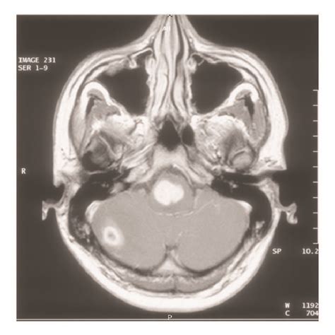 MRI scan during treatment phases. At diagnosis (a), one month after... | Download Scientific Diagram