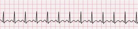 Análisis Del Ritmo Cardíaco Cerebromedico