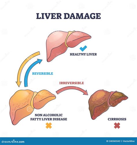 Liver Damage Stages with Reversible and Irreversible Disease Outline