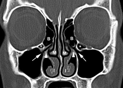 Ct Scan Sinusitis Paranasal Sinuses