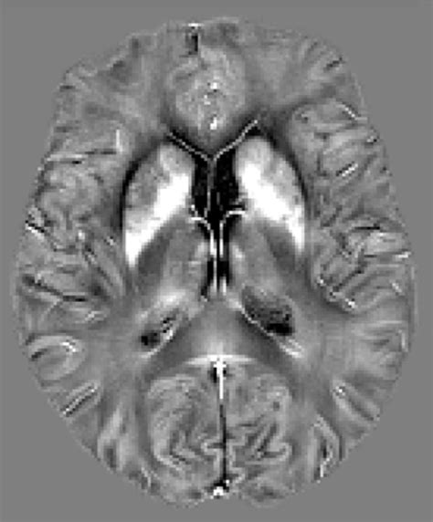 Quantitative Susceptibility Mapping Questions And Answers In Mri