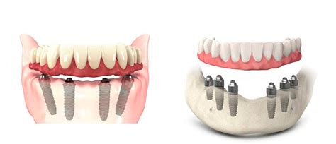 Diferença da prótese protocolo x dentadura AGN Odontologia