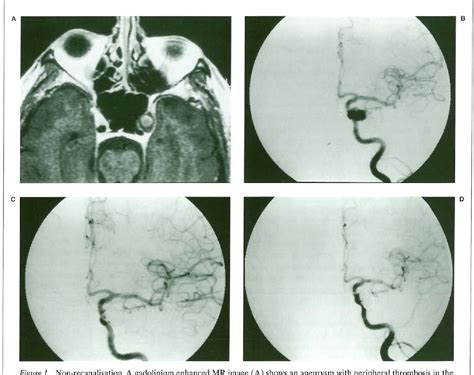 Figure 1 From GDC Embolisation Of Cavernous Internal Carotid Artery