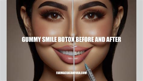 Gummy Smile Botox Before And After A Comprehensive Guide