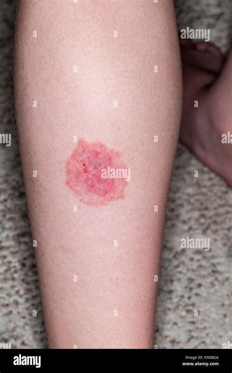 Impetigo Banque de photographies et dimages à haute résolution Alamy