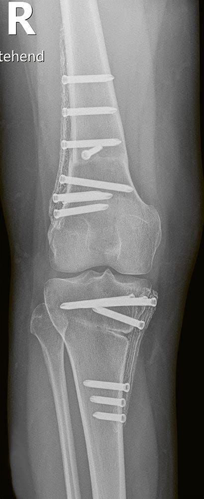 Knieschmerz Instabilität der Patella und Arthrose ATOS NEWS