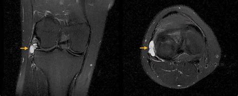 Tear Of The Lateral Meniscus With An Associated Parameniscal Cyst