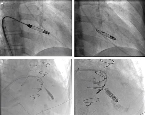 Leadless Cardiac Pacing What Primary Care Providers And Non Ep