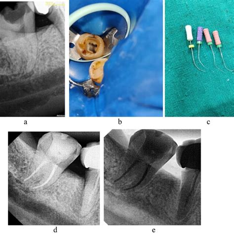 PDF Endodontic Management Of Curved Canals In Mandibular Molars A