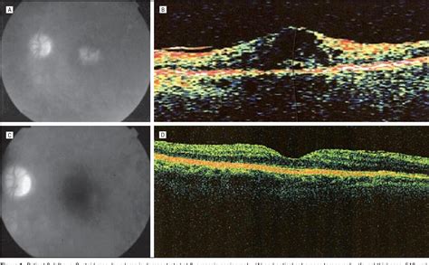 Figure 1 From Octreotide As A Treatment For Uveitic Cystoid Macular