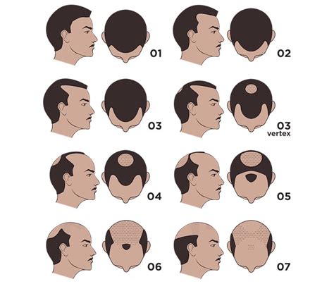 The Norwood Scale Hair Loss Stages Scalp Micro Usa