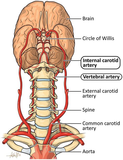 Vascular Disease Patient Information Page Cervical Artery Dissection