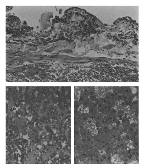 Hemorrhagic Ulceration Of The Mucosa Of Urinary Bladder With Severe