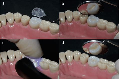 Rehabilitation of the occlusal surface with a resin-based composite ...