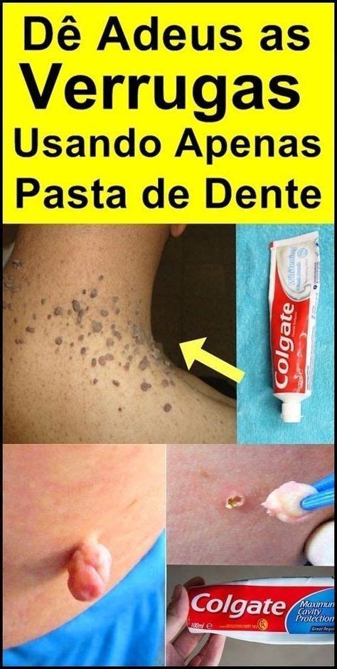 Remedios Naturales Para Eliminar Las Verrugas De Tu Cuerpo Artofit