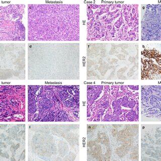 Four examples of HER2 status evolution from primary breast cancer to ...