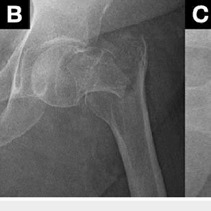 A An Anteroposterior Radiograph Of The Left Hip And An Oblique