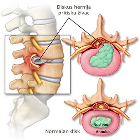 Diskus Hernija Lije Enje Uzroci Simptomi I Dijagnoza