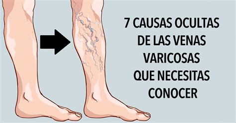 7 Causas Ocultas De Las Venas Varicosas Que Necesitas Conocer Conocer