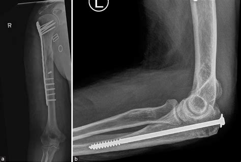 Orthopedic Hardware In Trauma A Guided Tour For The Radiologist