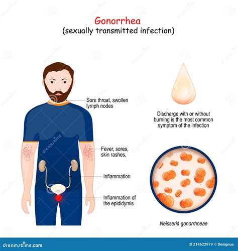 Gonorrhea Is A Sexually Transmitted Infection Sti Stock Vector