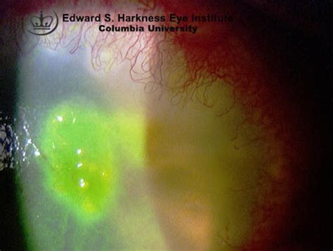 Bacterial Corneal Ulcer Vagelos College Of Physicians And Surgeons