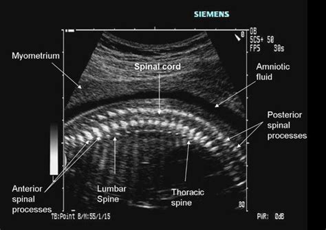 My Fetal Spine Flashcards Quizlet