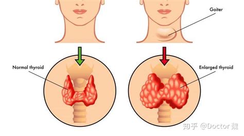 甲状腺结节4级严重吗，是不是就是癌了？医生：建议做手术！ 知乎