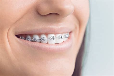 Metal Braces Options Sault Ste Marie Orthodontic Specailists