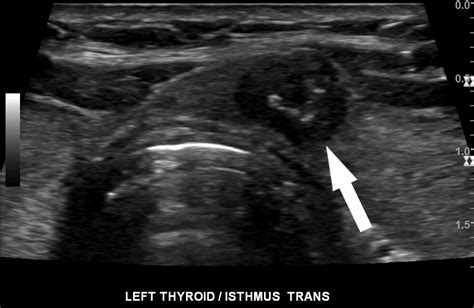 Thyroid Ultrasound Cancer