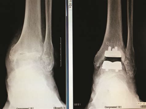 Ankle Replacement Surgery Md Update