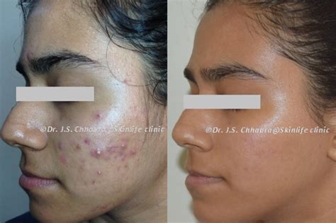 Acne And Scar Reduction Treatment In Indore Dr Chhabras Skin Life Clinic