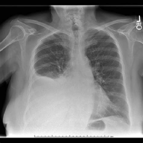 Pdf Recurrent Unilateral Transudative Pleural Effusion Due To Low