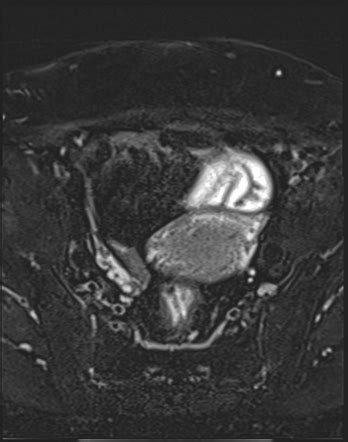 Uterine Lipoleiomyoma Image Radiopaedia Org