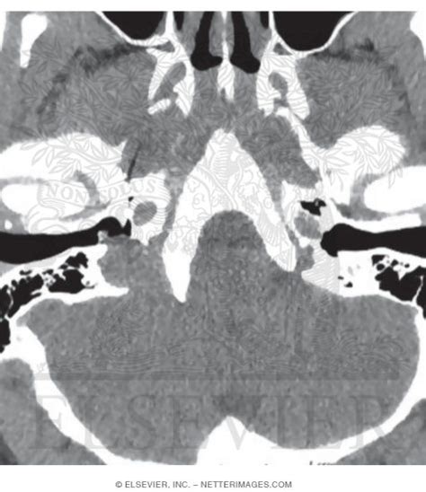 Axial Ct Showing The Jugular Bulb Extending Into The Middle Ear Cavity