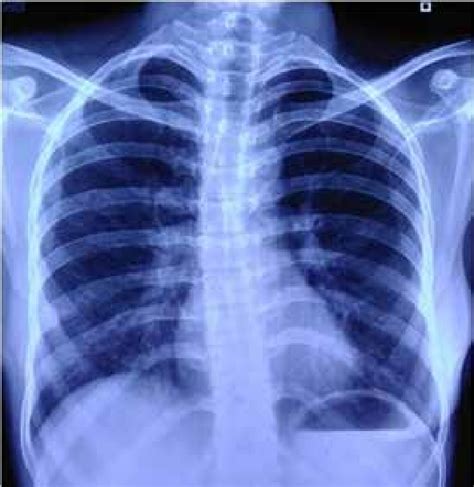 Follow Up Chest Radiograph Postero Anterior View Demonstrating