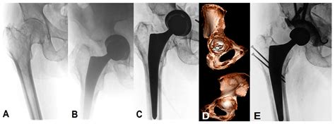 Medicina Free Full Text Revision Of A Failed Primary Total Hip