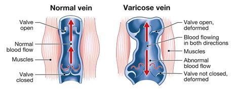 The 6 Stages Of Varicose Veins The Vein Institute