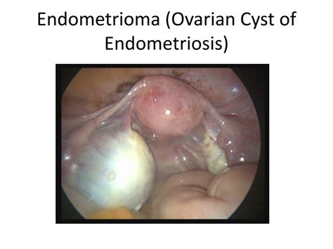 Ppt Laparoscopy Normal Powerpoint Presentation Free Download Id